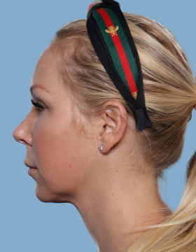 Buccal Fat Removal before - front view