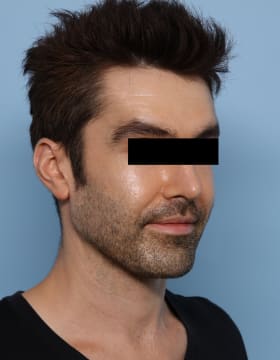 Chin Implants after - oblique right