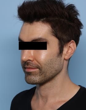 Chin Implants after - oblique left