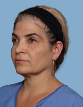 Blepharoplasty before - oblique left