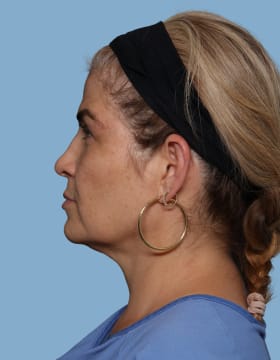 Blepharoplasty before - side left