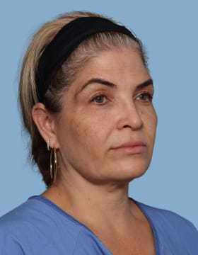 Blepharoplasty before - oblique right