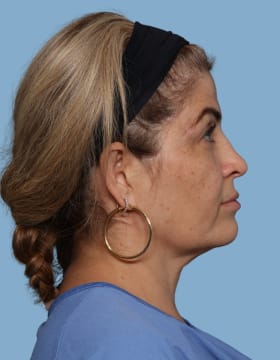 Blepharoplasty before - side right