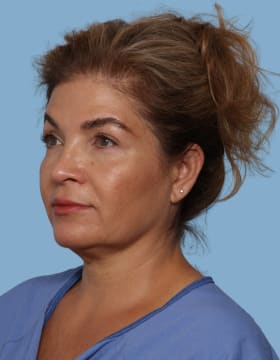 Blepharoplasty after - oblique left