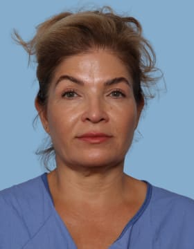 Blepharoplasty after - front view