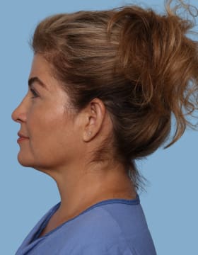 Blepharoplasty after - side left