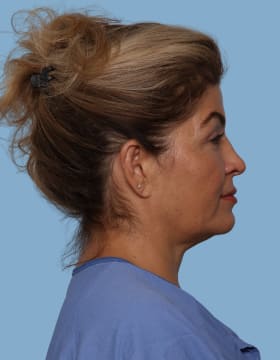 Blepharoplasty after - side right