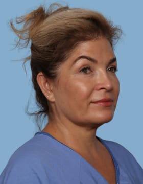 Blepharoplasty after - oblique right