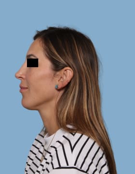 Rhinoplasty after - side left