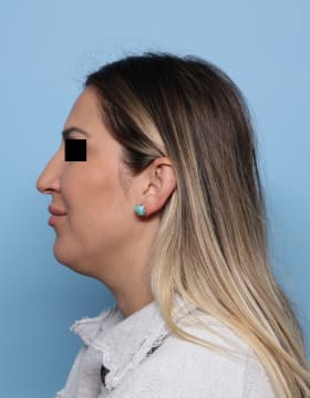 Rhinoplasty before - side left