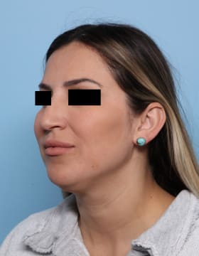 Rhinoplasty before - oblique left