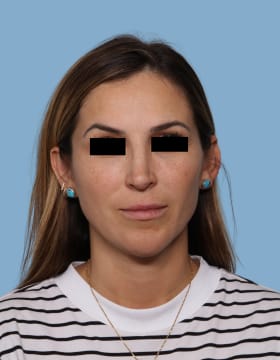 Rhinoplasty after - front view
