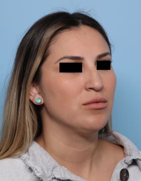 Rhinoplasty before - oblique right