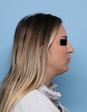 Rhinoplasty before - side right