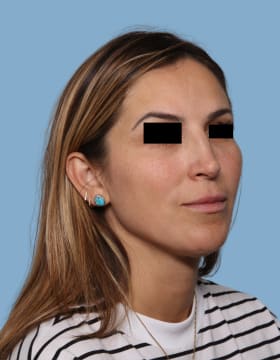 Rhinoplasty after - oblique right