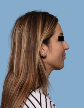 Rhinoplasty after - side right