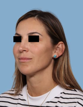 Rhinoplasty after - oblique left