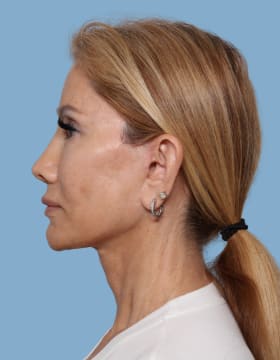 Blepharoplasty after - side left