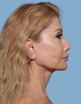 Blepharoplasty before - side right