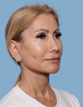 Blepharoplasty after - oblique right