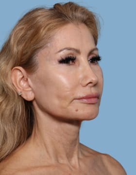 Blepharoplasty before - oblique right