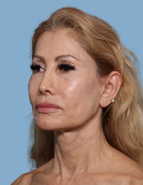 Facelift before - oblique left