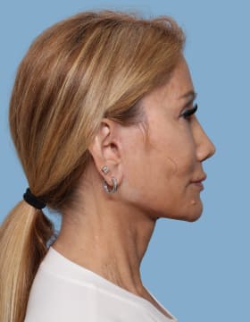 Facelift after - side right