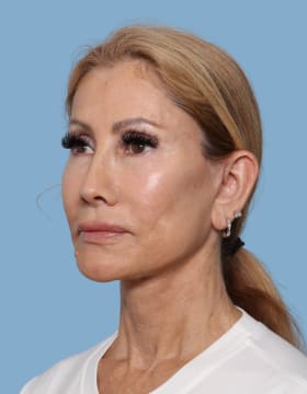Facelift after - oblique left