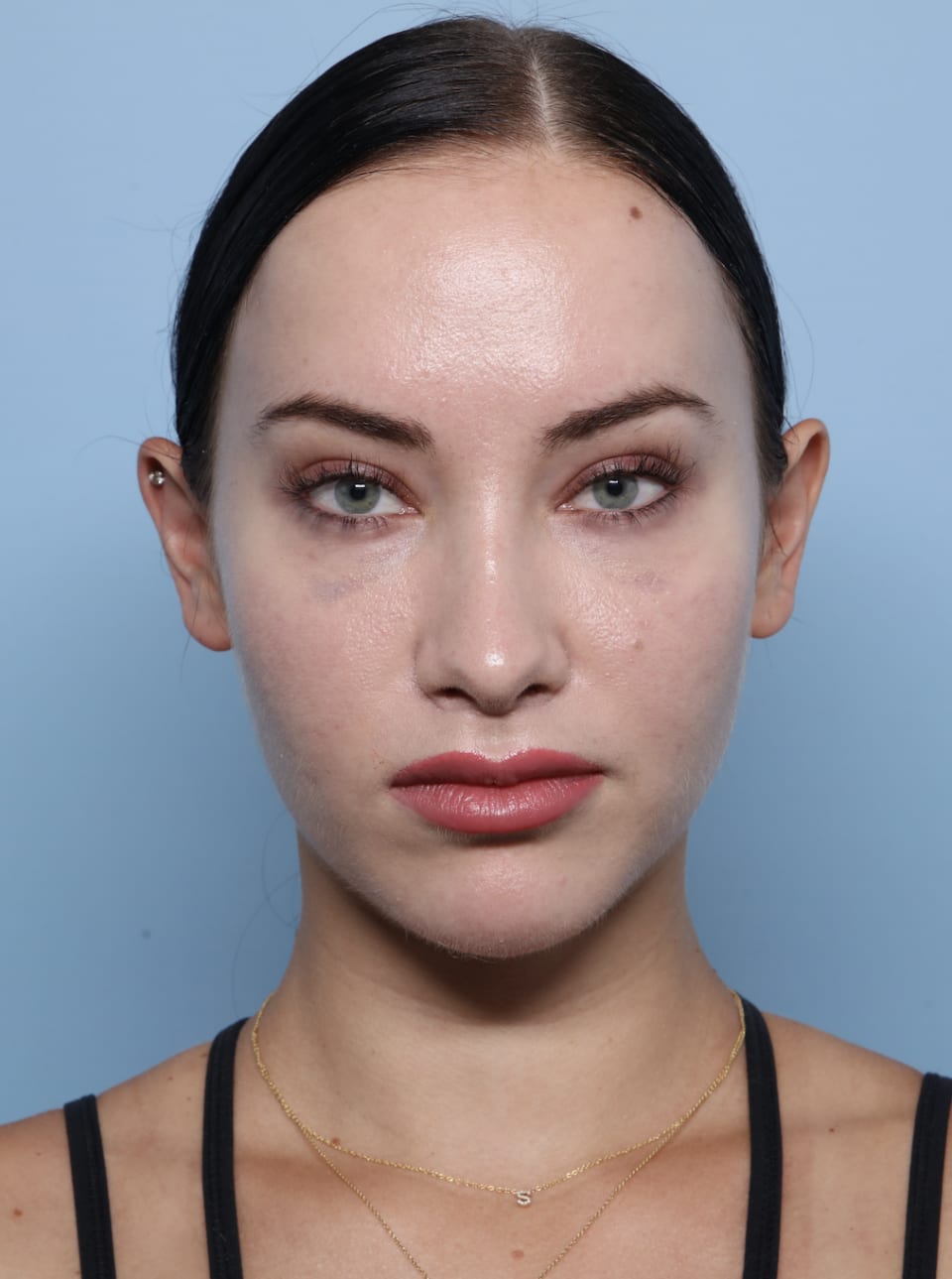Brow Lift after - front view