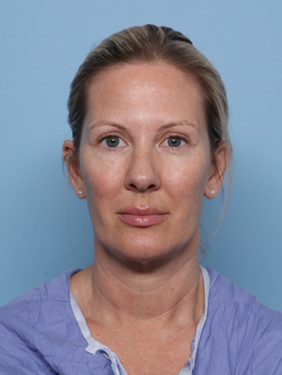Blepharoplasty after - front view