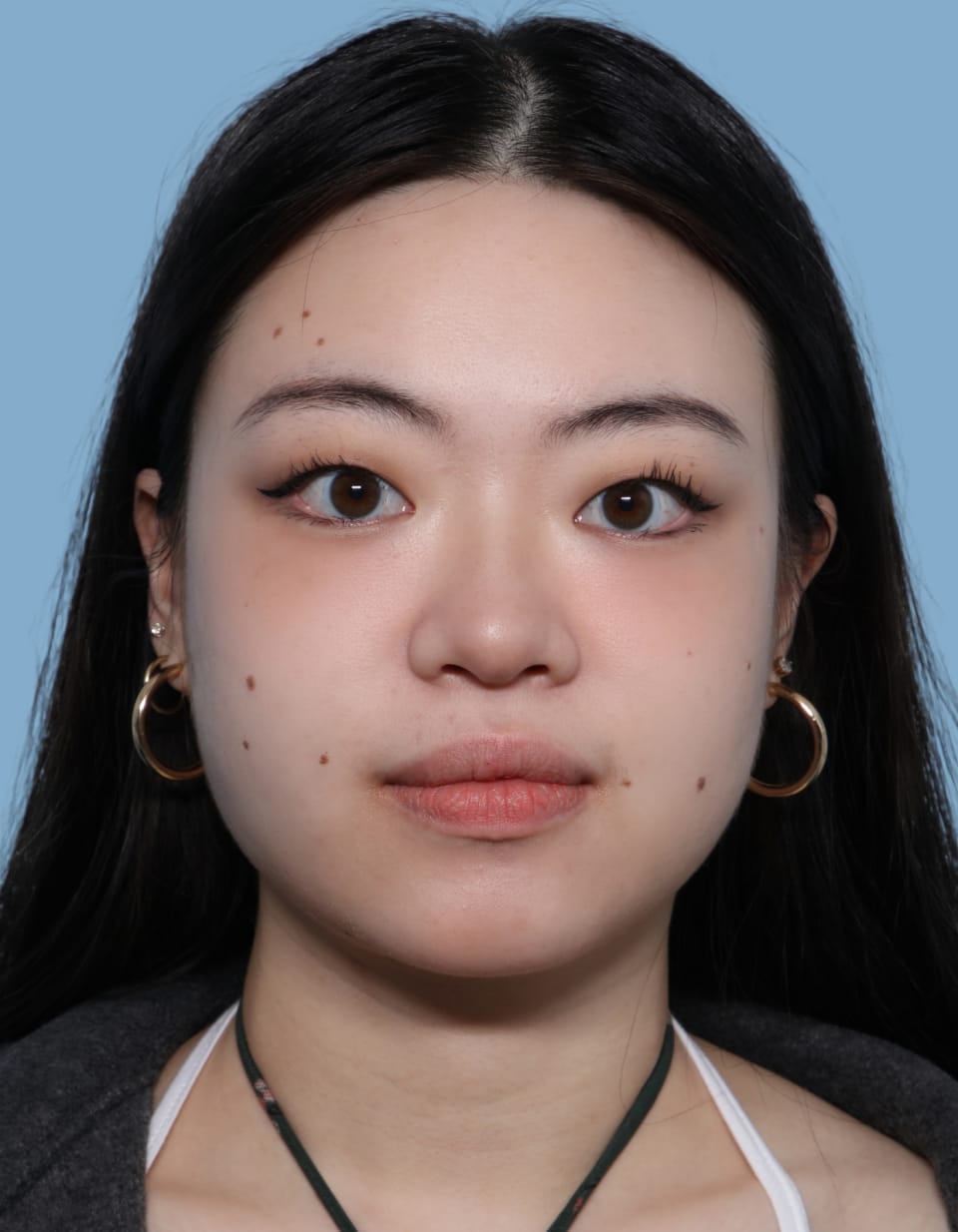Buccal Fat Removal after - front view