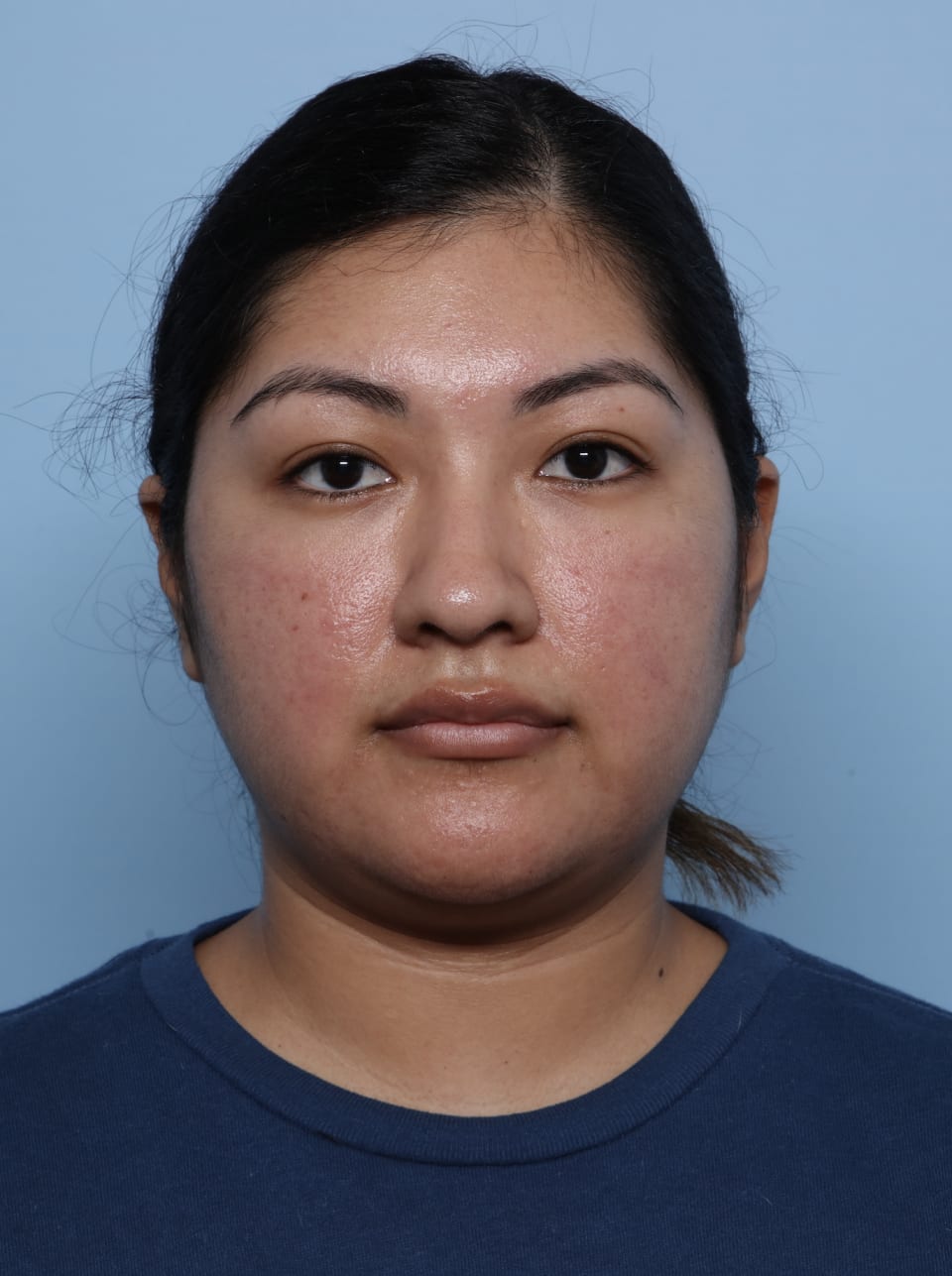 Buccal Fat Removal before - front view