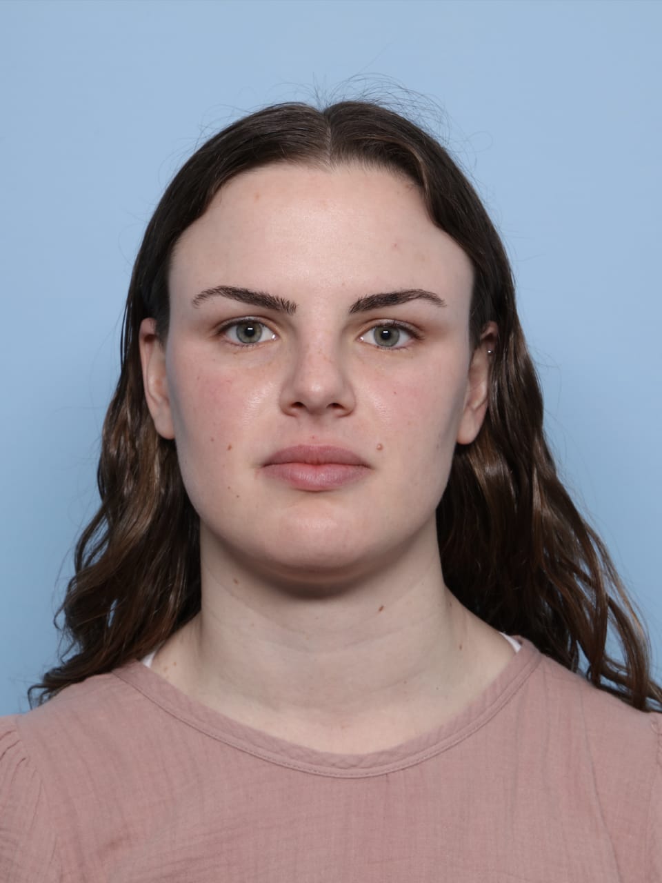 Buccal Fat Removal after - front view
