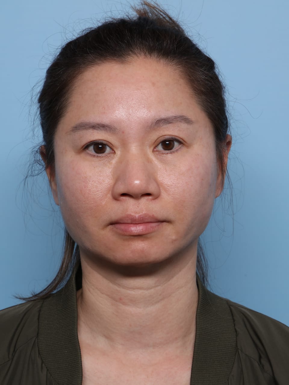 Buccal Fat Removal after - front view