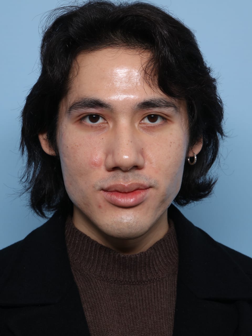 Buccal Fat Removal before - front view