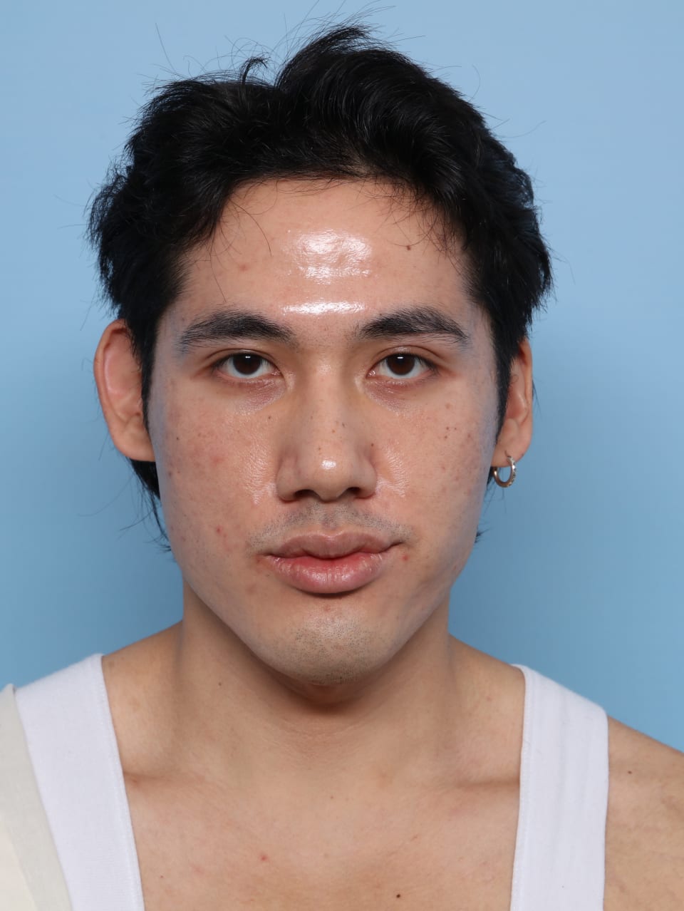 Buccal Fat Removal after - front view