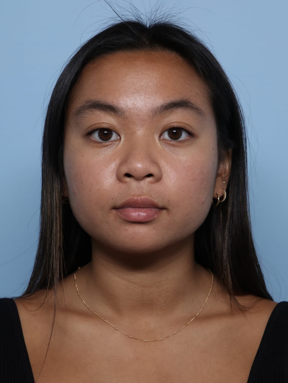 Buccal Fat Removal before - front view