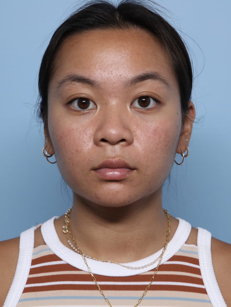 Buccal Fat Removal after - front view