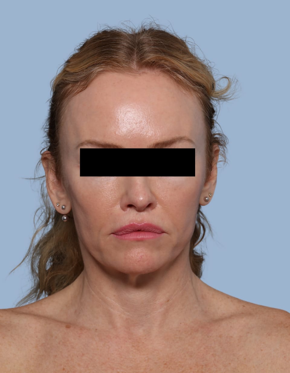Deep Plane Facelift before - front view