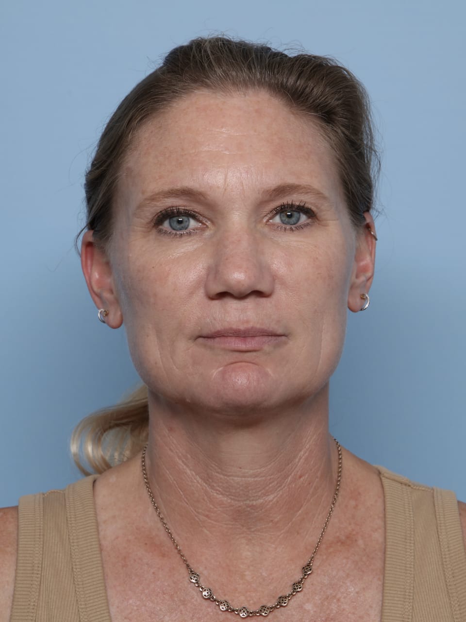 Facelift before - front view