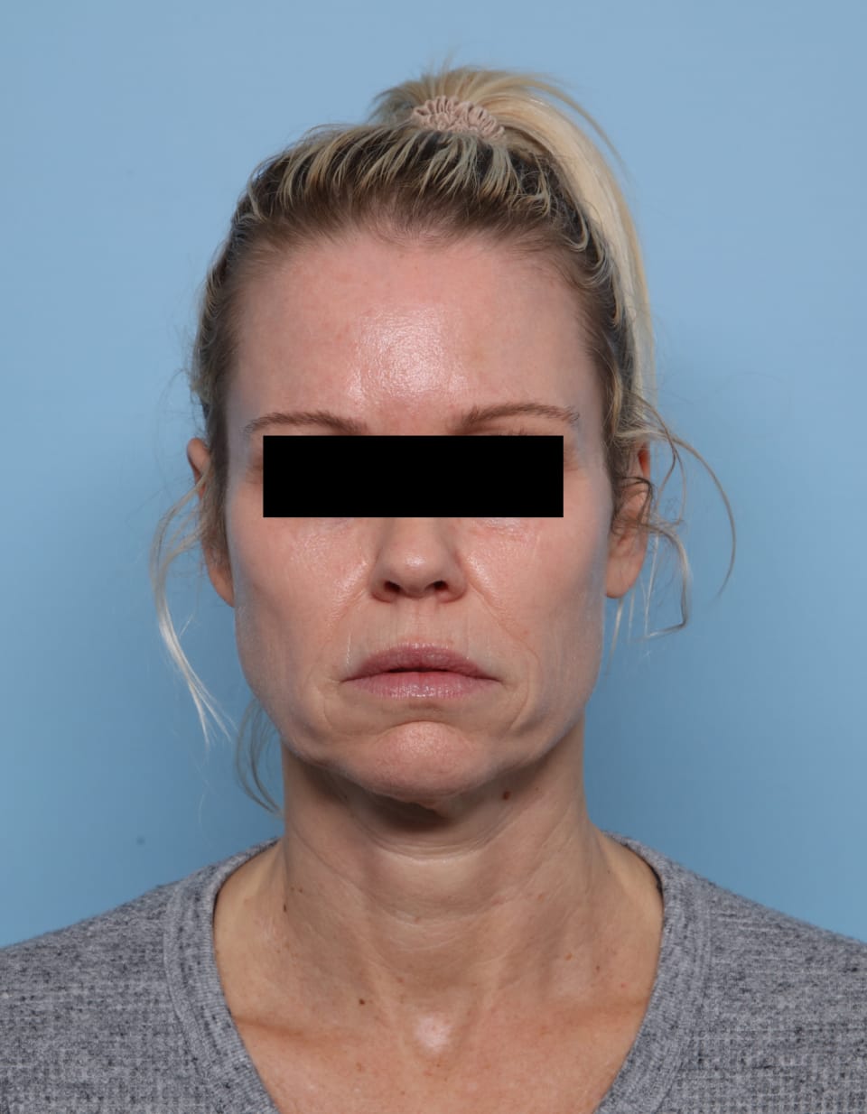 Facelift before - front view