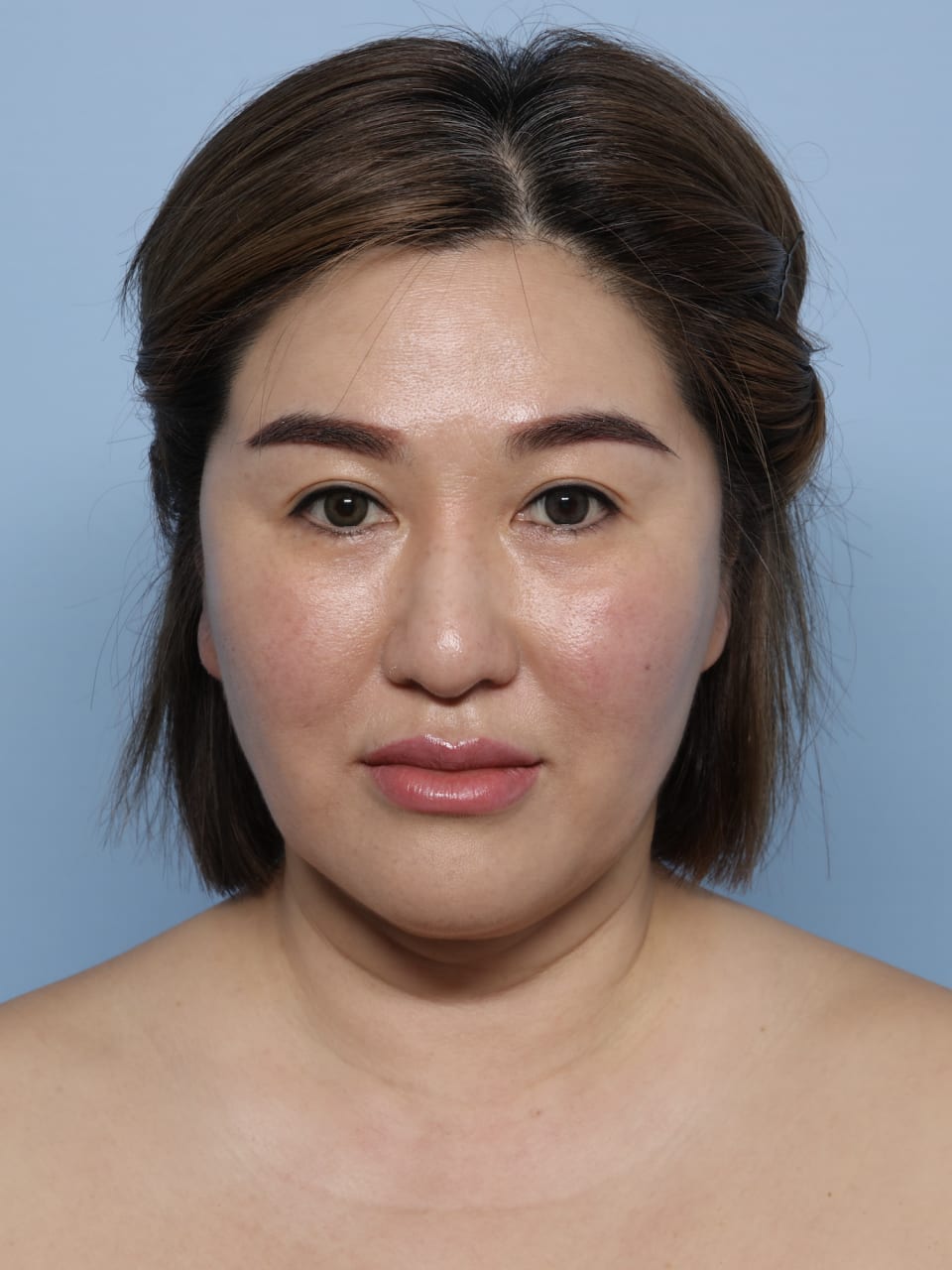Facelift before - front view