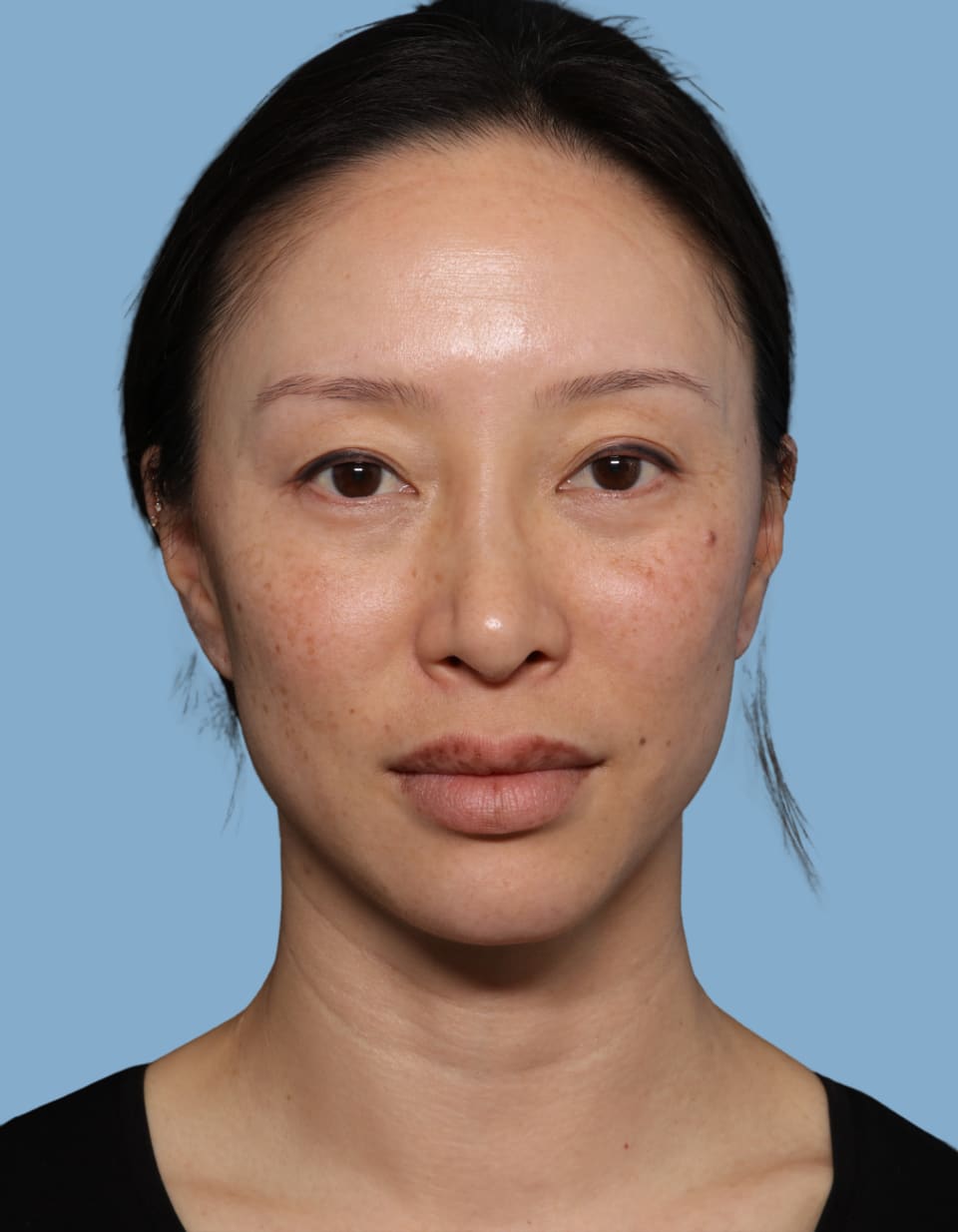 Blepharoplasty before - front view