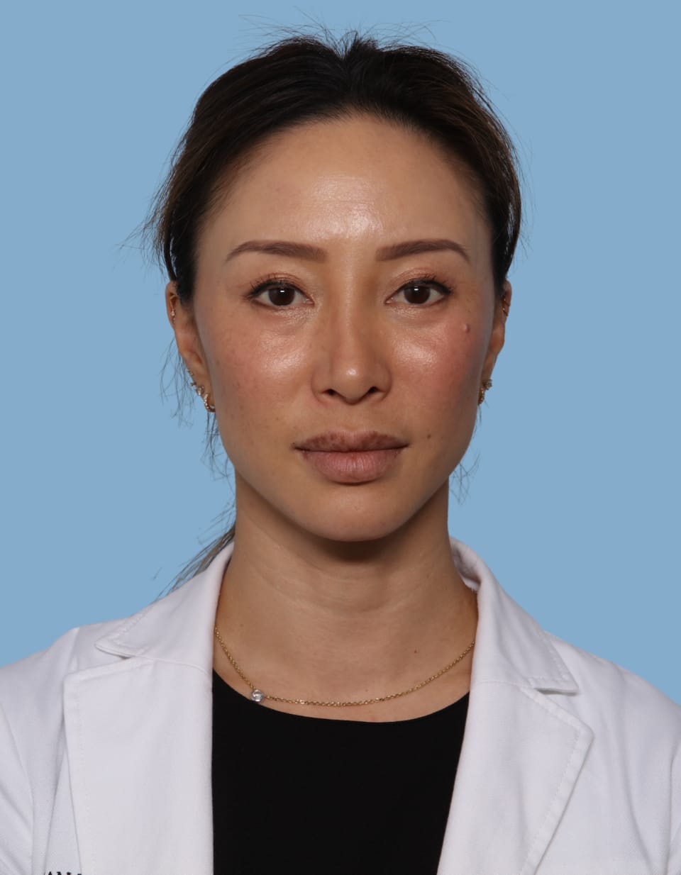 Blepharoplasty after - front view
