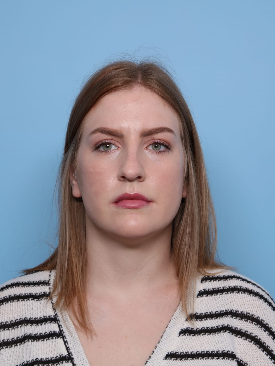 Rhinoplasty before - front view