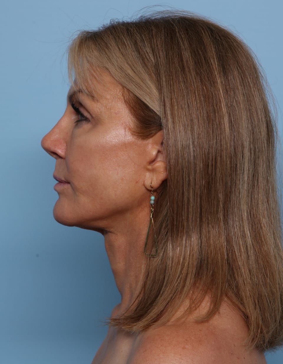 Rhinoplasty after - front view
