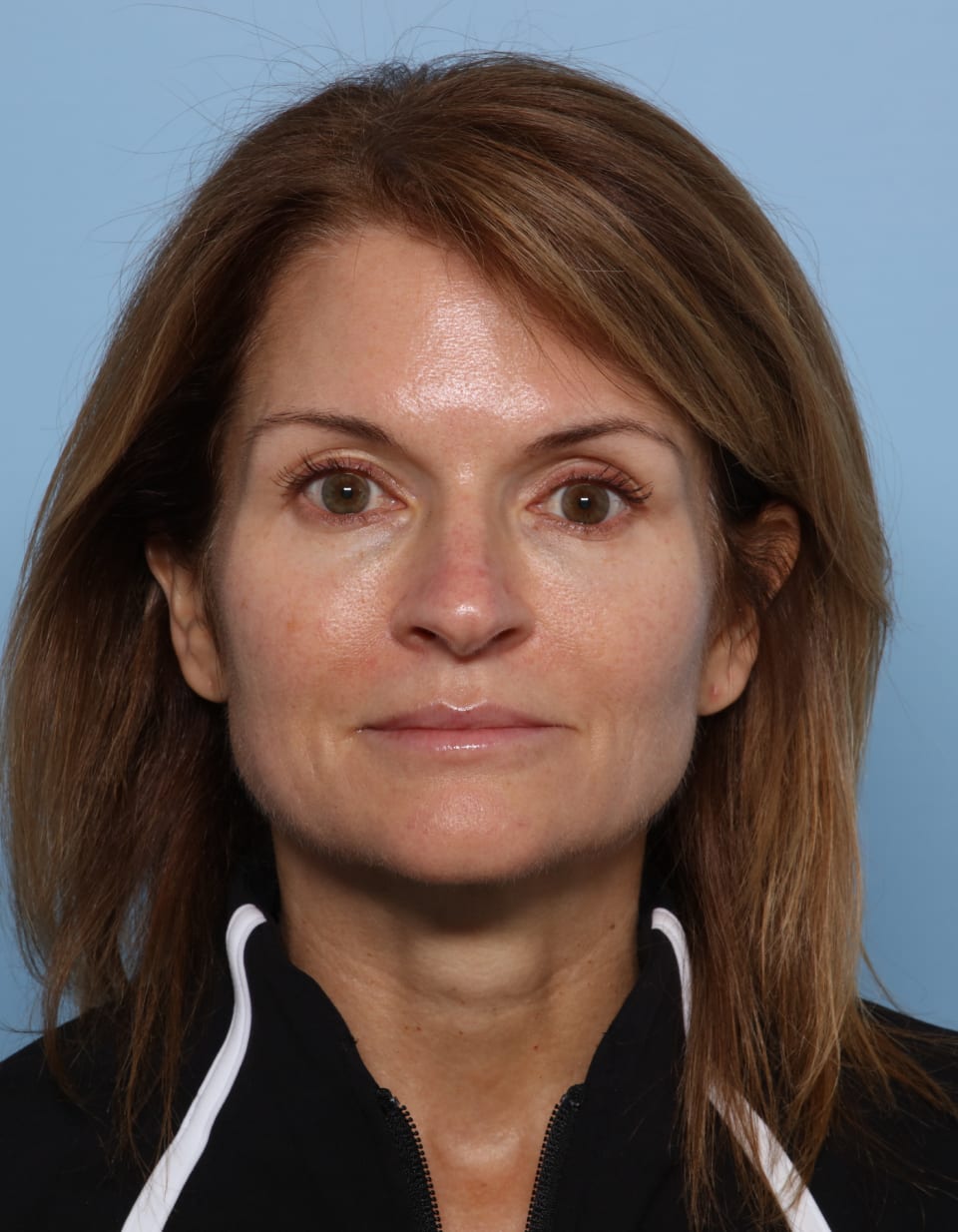 Rhinoplasty before - front view
