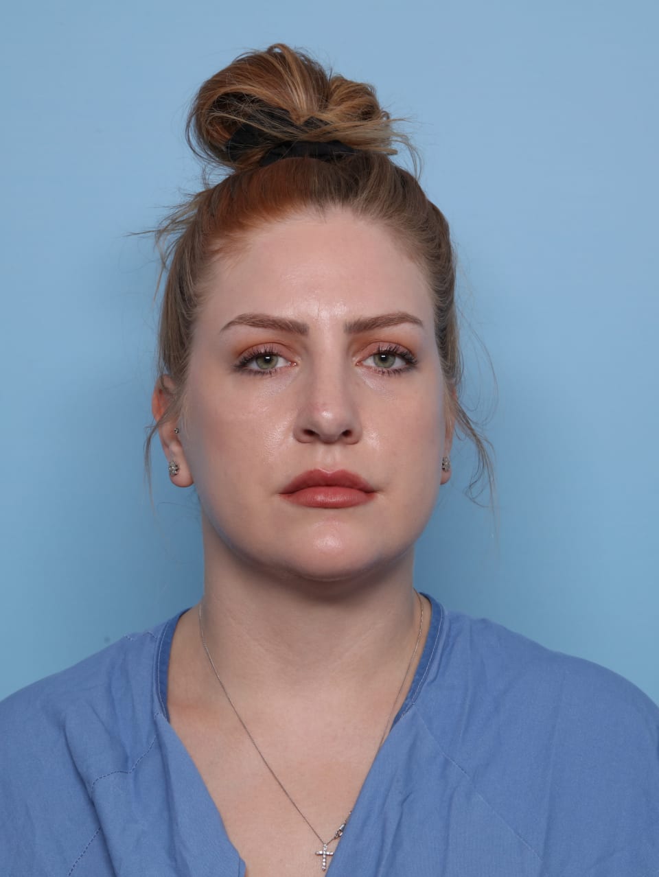 Rhinoplasty after - front view