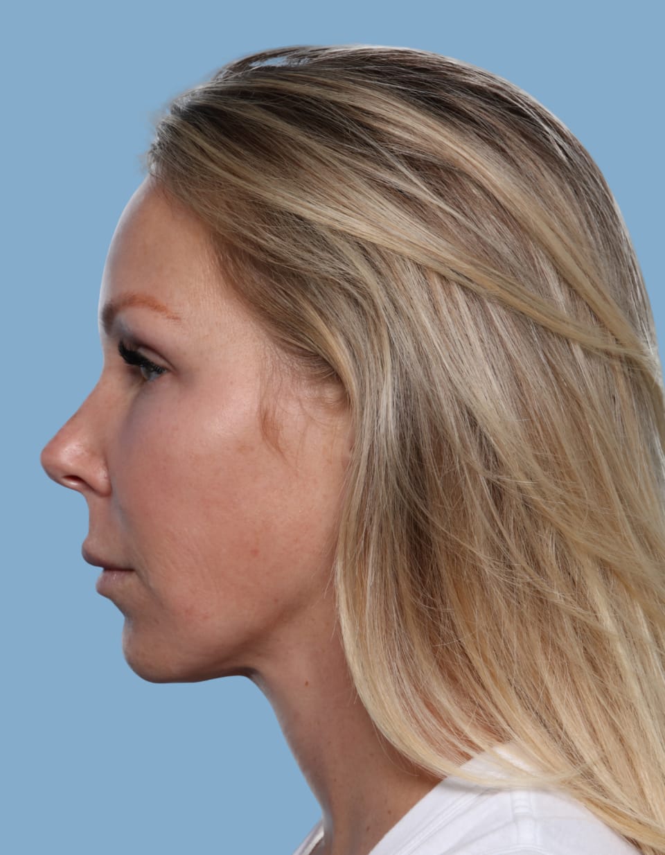 Buccal Fat Removal after - front view