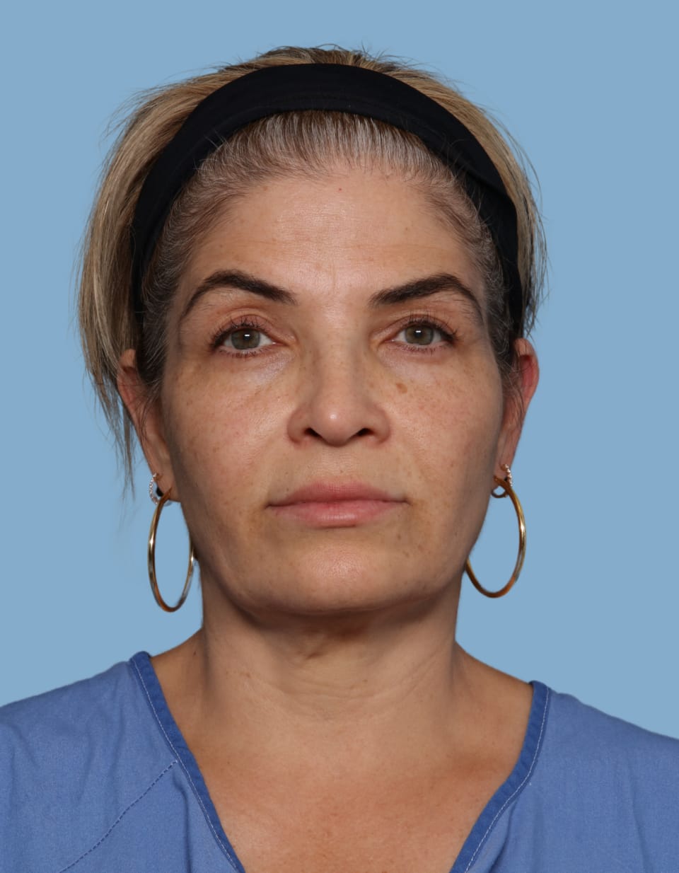 Blepharoplasty before - front view